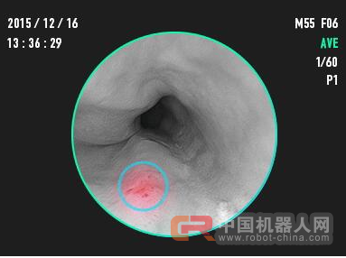 腾讯也对医疗AI动手了 可筛查早期食管癌