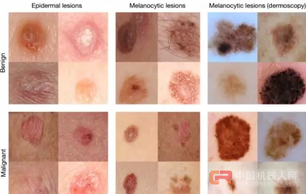 斯坦福大学用人工智能来诊断皮肤癌，准确率达91%