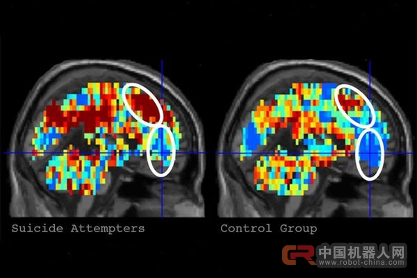算法可以使用脑部扫描识别有自杀念头的人