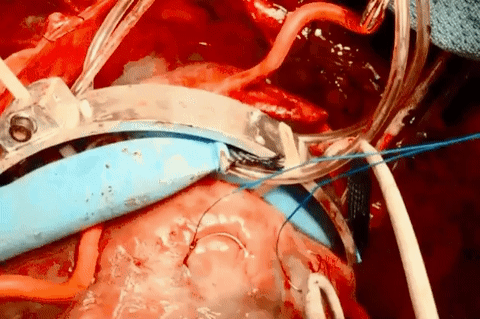 这个机器人可以通过轻轻挤压帮助保持猪心跳动